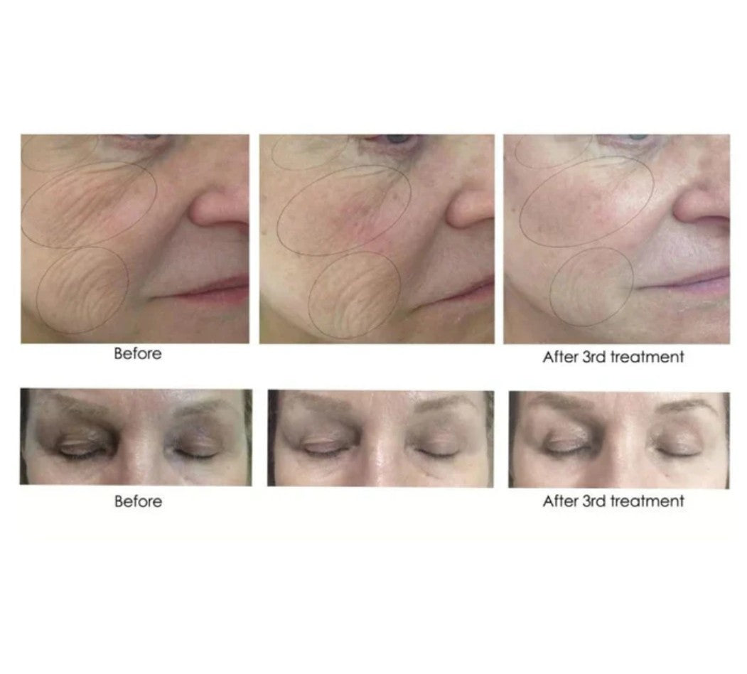 CO2Lift Carboxy Gel Mask