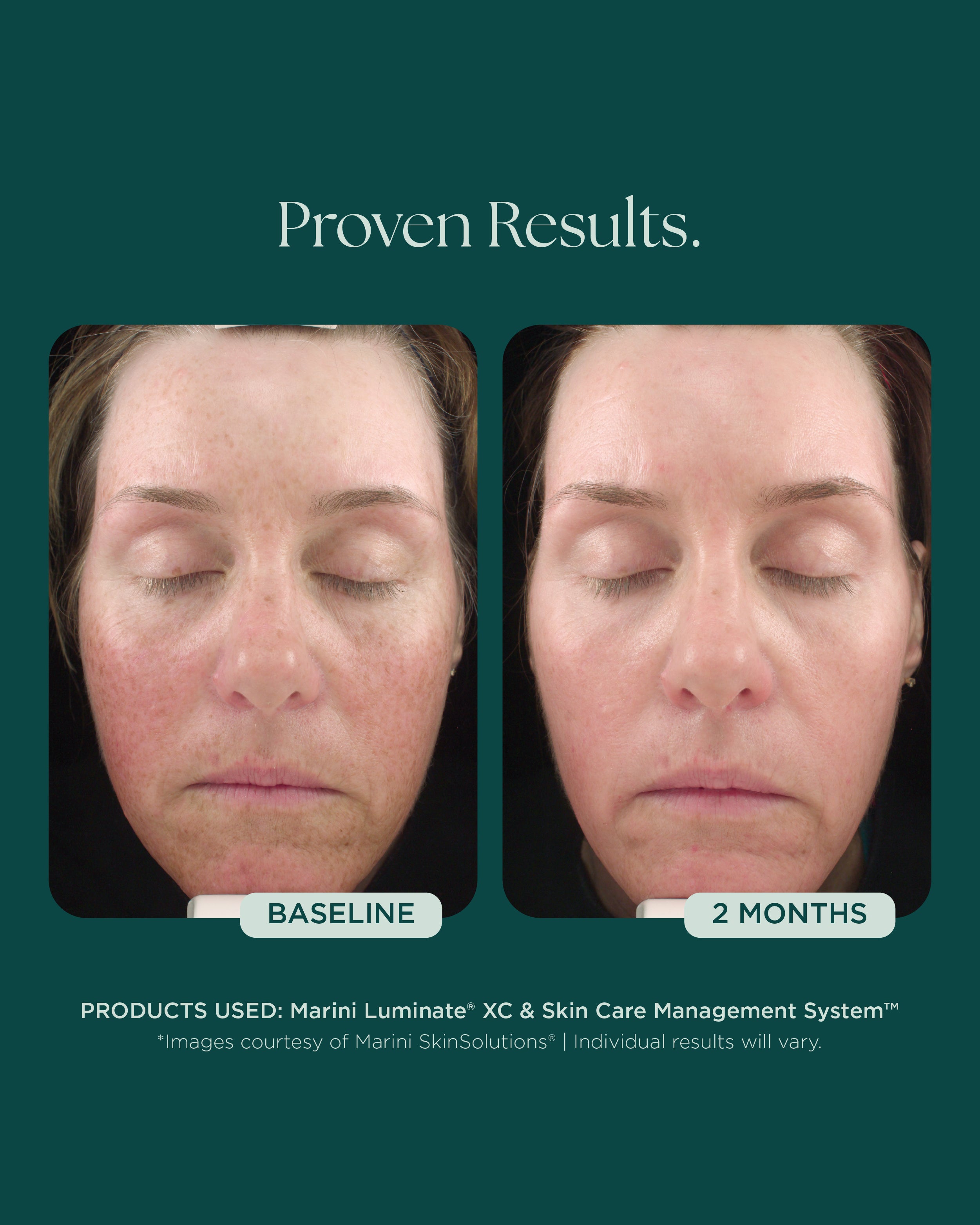 Marini Luminate® XC